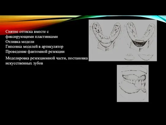 Моделировка резекционной части, постановка искусственных зубов Снятие оттиска вместе с фиксирующими пластинками