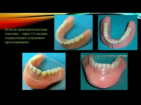 Если не проводится костная пластика – через 3-4 месяца осуществляют отдаленное протезирование