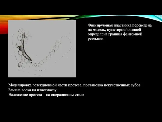 Фиксирующая пластинка переведена на модель, пунктирной линией определена граница фантомной резекции Моделировка