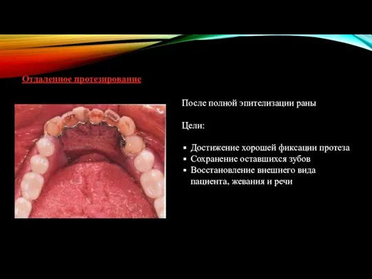 Отдаленное протезирование После полной эпителизации раны Цели: Достижение хорошей фиксации протеза Сохранение