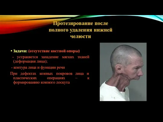 Протезирование после полного удаления нижней челюсти Задачи: (отсутствие костной опоры) - устраняется