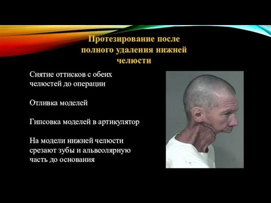 Протезирование после полного удаления нижней челюсти Снятие оттисков с обеих челюстей до