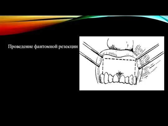 Проведение фантомной резекции