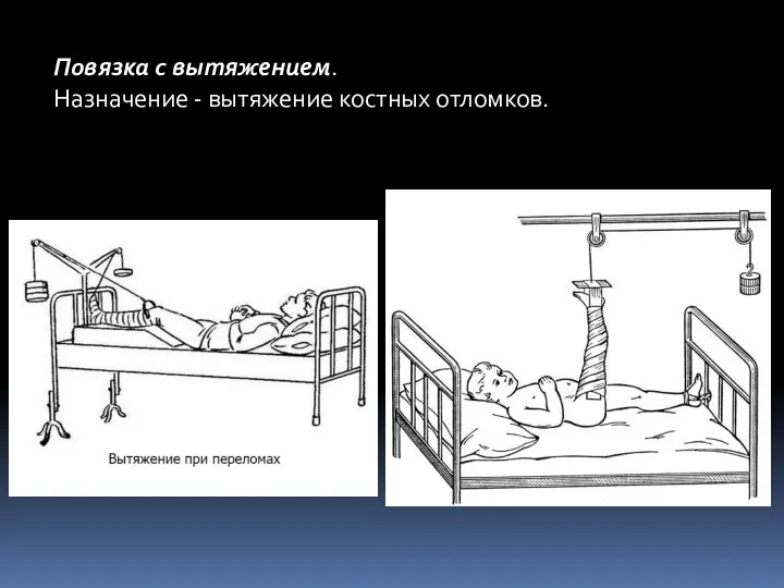 Повязка с вытяжением. Назначение - вытяжение костных отломков.