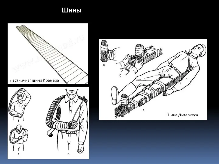 Шины Лестничная шина Крамера Шина Дитерихса