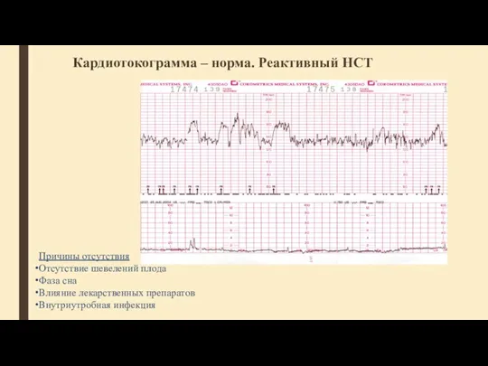 Кардиотокограмма – норма. Реактивный НСТ Причины отсутствия Отсутствие шевелений плода Фаза сна