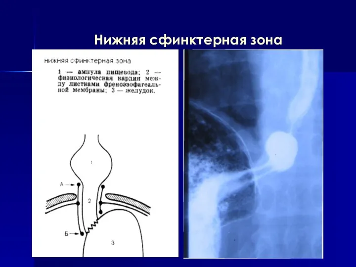 Нижняя сфинктерная зона
