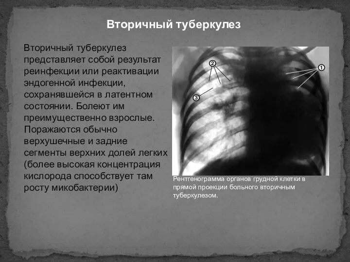 Вторичный туберкулез Вторичный туберкулез представляет собой результат реинфекции или реактивации эндогенной инфекции,