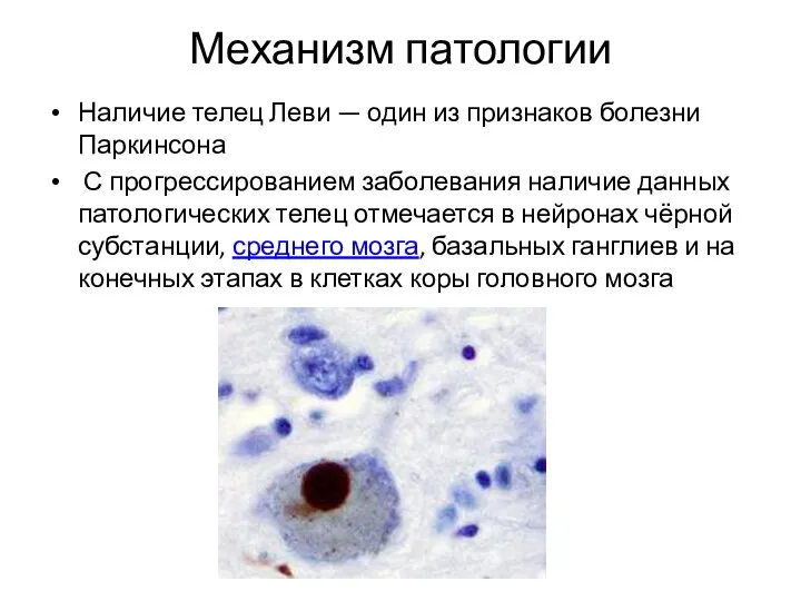 Механизм патологии Наличие телец Леви — один из признаков болезни Паркинсона С