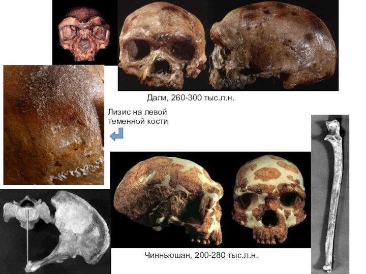 Дали, 260-300 тыс.л.н. Лизис на левой теменной кости Чинньюшан, 200-280 тыс.л.н.