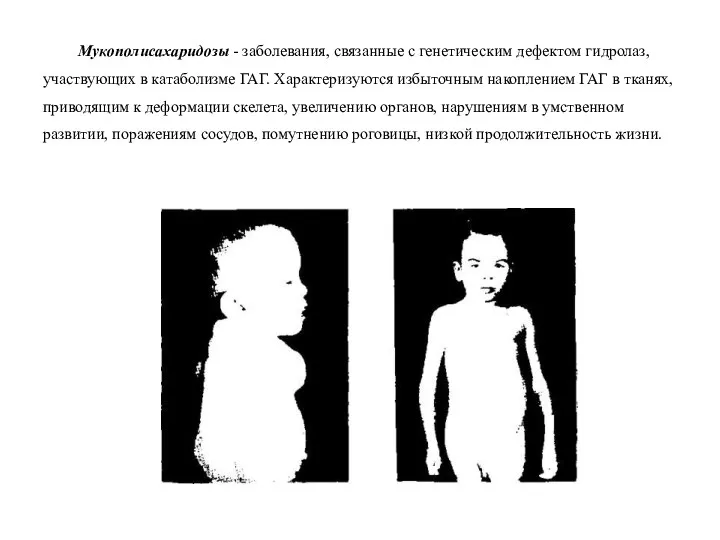 Мукополисахаридозы - заболевания, связанные с генетическим дефектом гидролаз, участвующих в катаболизме ГАГ.