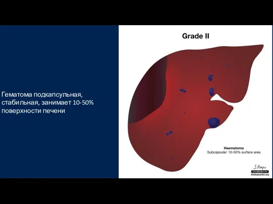 Маневр Прингла Гематома подкапсульная, стабильная, занимает 10-50% поверхности печени