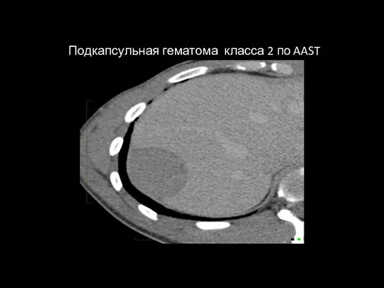 Подкапсульная гематома класса 2 по AAST