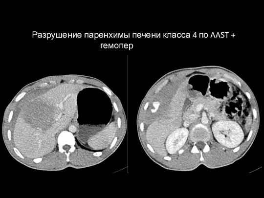 Разрушение паренхимы печени класса 4 по AAST + гемоперитонеум