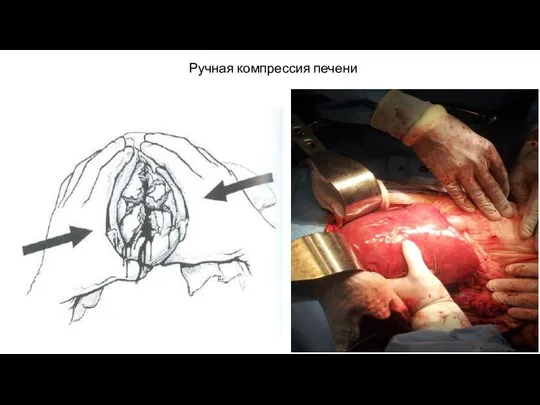 Ручная компрессия печени