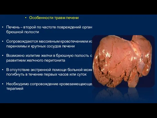 Особенности травм печени Печень – второй по частоте повреждений орган брюшной полости