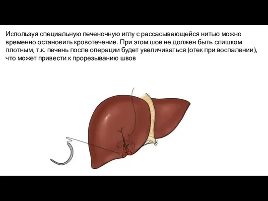 Используя специальную печеночную иглу с рассасывающейся нитью можно временно остановить кровотечение. При