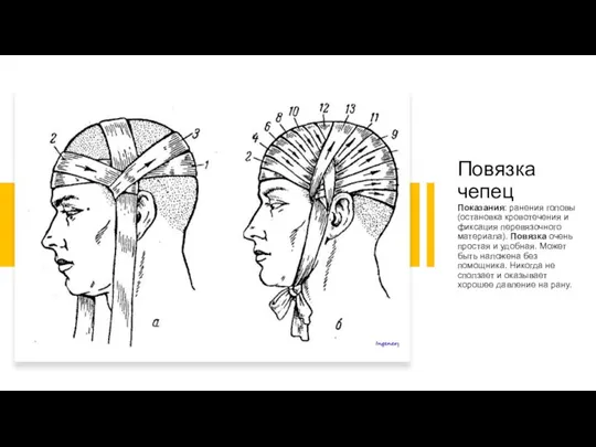 Повязка чепец Показания: ранения головы (остановка кровотечения и фиксация перевязочного материала). Повязка