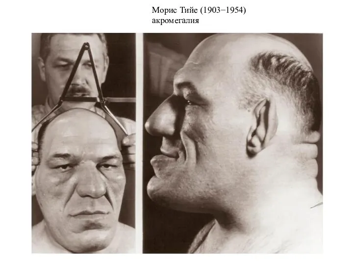 Морис Тийе (1903−1954) акромегалия