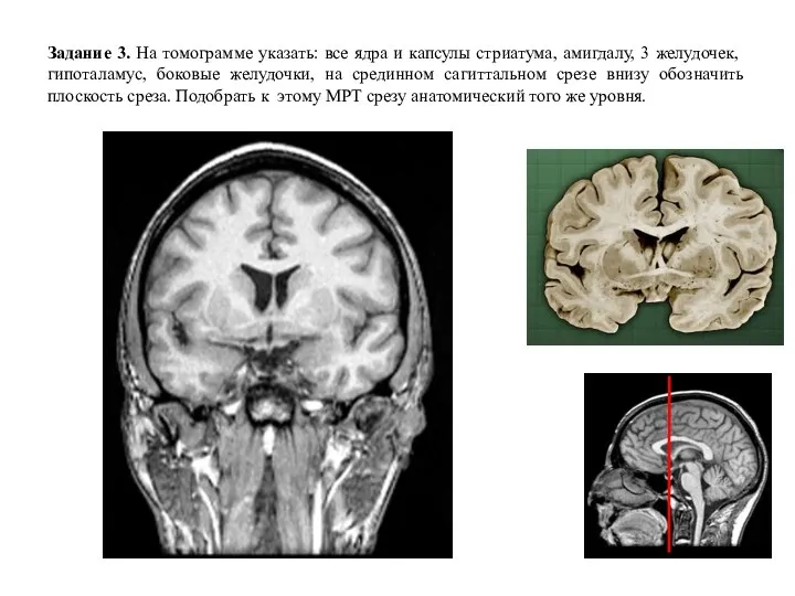 Задание 3. На томограмме указать: все ядра и капсулы стриатума, амигдалу, 3