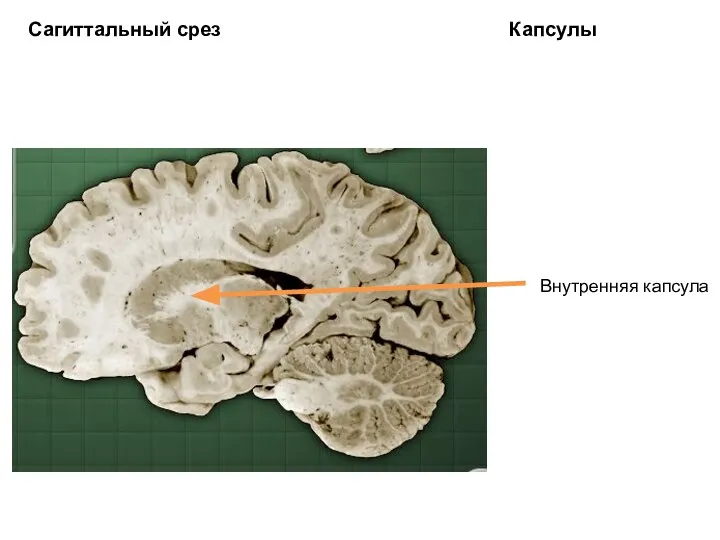 Сагиттальный срез Капсулы Внутренняя капсула