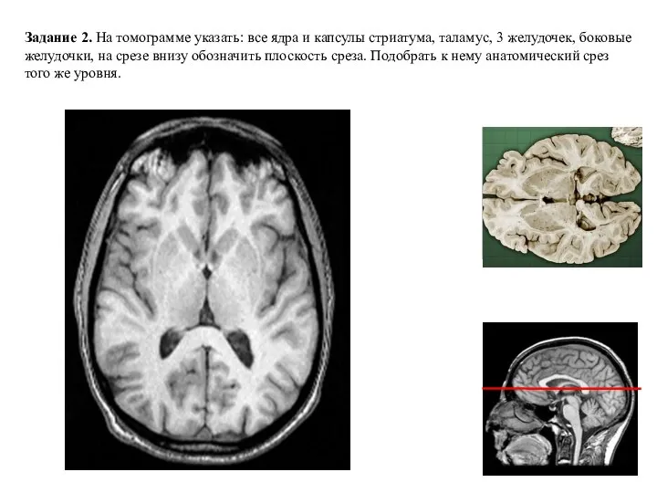 Задание 2. На томограмме указать: все ядра и капсулы стриатума, таламус, 3