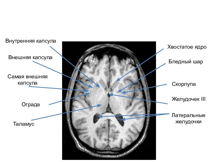 Хвостатое ядро Бледный шар Скорлупа Ограда Желудочек III Латеральные желудочки Внутренняя капсула