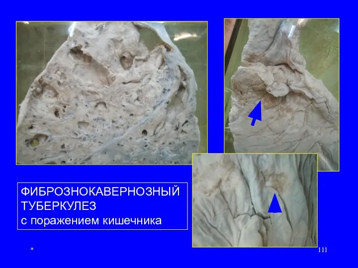 * ФИБРОЗНОКАВЕРНОЗНЫЙ ТУБЕРКУЛЕЗ с поражением кишечника