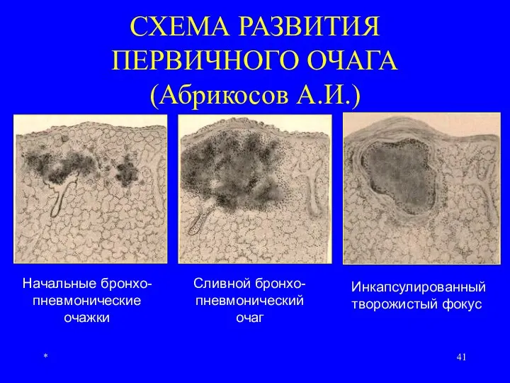 * СХЕМА РАЗВИТИЯ ПЕРВИЧНОГО ОЧАГА (Абрикосов А.И.) Начальные бронхо- пневмонические очажки Сливной