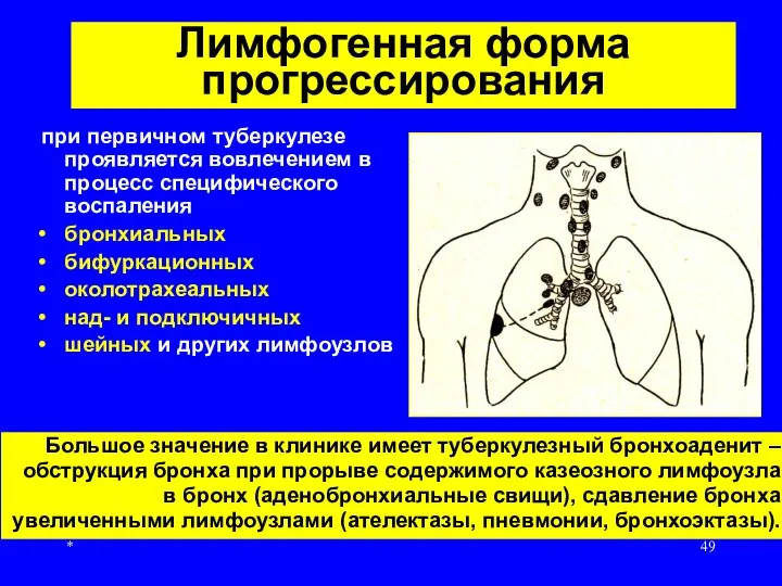 * Лимфогенная форма прогрессирования при первичном туберкулезе проявляется вовлечением в процесс специфического