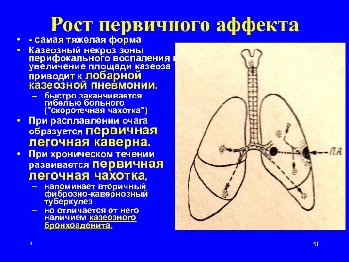 * Рост первичного аффекта - самая тяжелая форма Казеозный некроз зоны перифокального