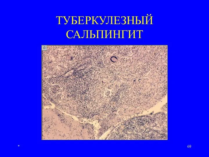 * ТУБЕРКУЛЕЗНЫЙ САЛЬПИНГИТ