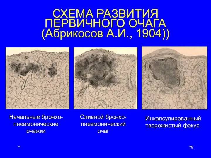 * СХЕМА РАЗВИТИЯ ПЕРВИЧНОГО ОЧАГА (Абрикосов А.И., 1904)) Начальные бронхо- пневмонические очажки