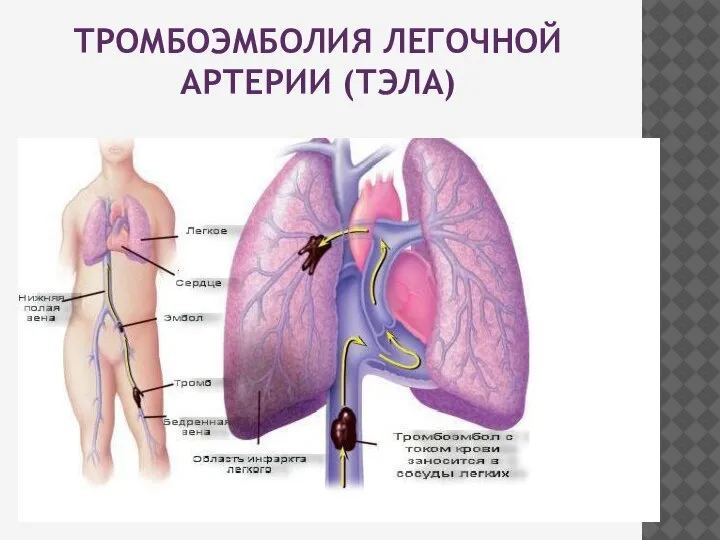 ТРОМБОЭМБОЛИЯ ЛЕГОЧНОЙ АРТЕРИИ (ТЭЛА)