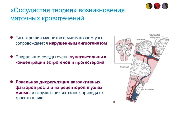 «Сосудистая теория» возникновения маточных кровотечений Гипертрофия миоцитов в миоматозном узле сопровождается нарушенным