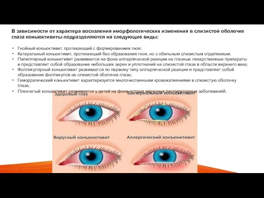 В зависимости от характера воспаления иморфологических изменений в слизистой оболочке глаза коньюктивиты