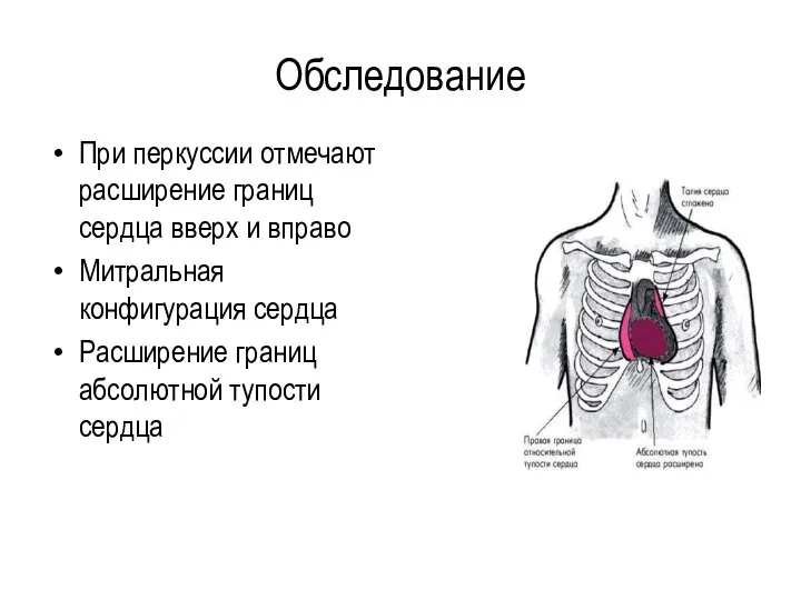 Обследование При перкуссии отмечают расширение границ сердца вверх и вправо Митральная конфигурация