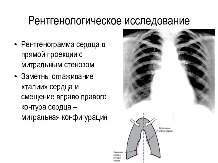 Рентгенологическое исследование Рентгенограмма сердца в прямой проекции с митральным стенозом Заметны сглаживание