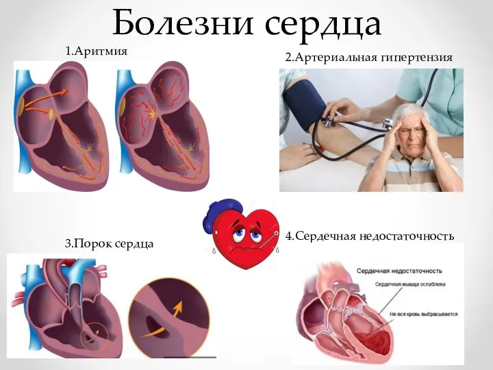 Болезни сердца 1.Аритмия 2.Артериальная гипертензия 3.Порок сердца 4.Сердечная недостаточность