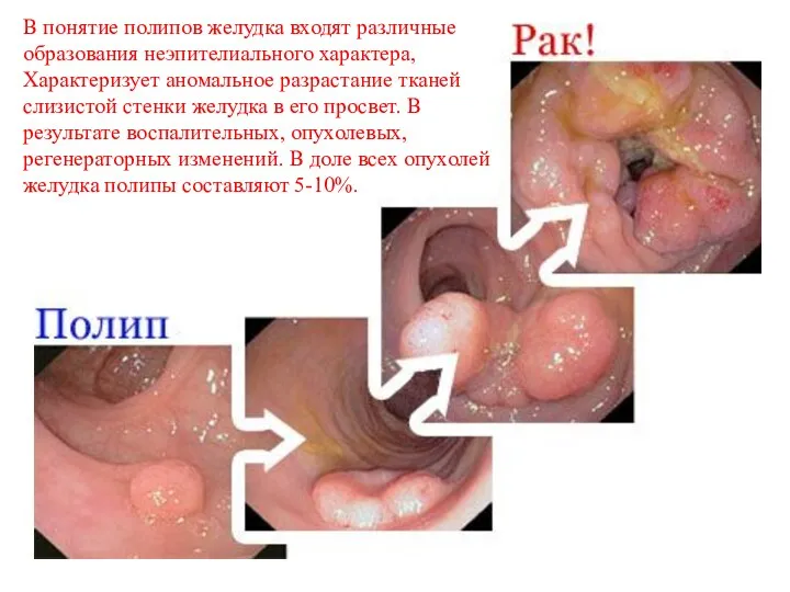 В понятие полипов желудка входят различные образования неэпителиального характера, Характеризует аномальное разрастание