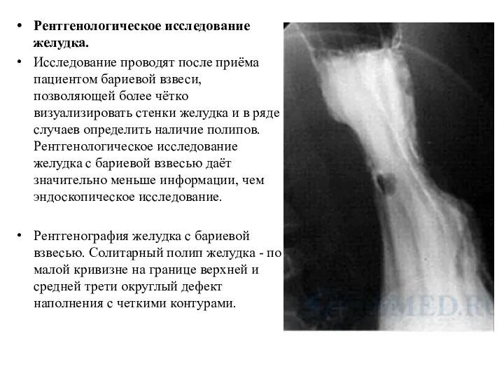 Рентгенологическое исследование желудка. Исследование проводят после приёма пациентом бариевой взвеси, позволяющей более
