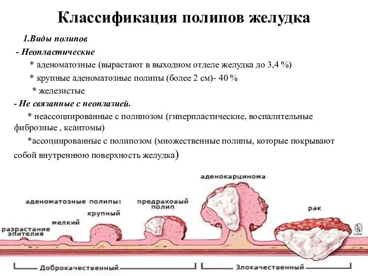 Классификация полипов желудка 1.Виды полипов - Неопластические * аденоматозные (вырастают в выходном