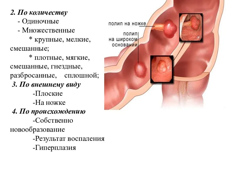 2. По количеству - Одиночные - Множественные * крупные, мелкие, смешанные; *