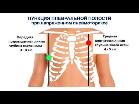 ПУНКЦИЯ ПЛЕВРАЛЬНОЙ ПОЛОСТИ при напряженном пневмотораксе