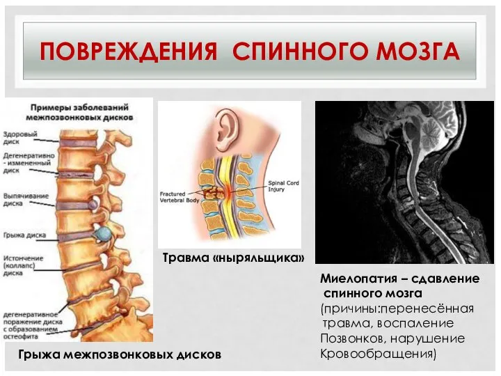 ПОВРЕЖДЕНИЯ СПИННОГО МОЗГА Травма «ныряльщика» Миелопатия – сдавление спинного мозга (причины:перенесённая травма,