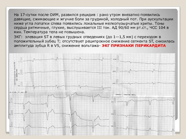 На 17-сутки после ОИМ, развился рецидив : рано утром внезапно появились давящие,