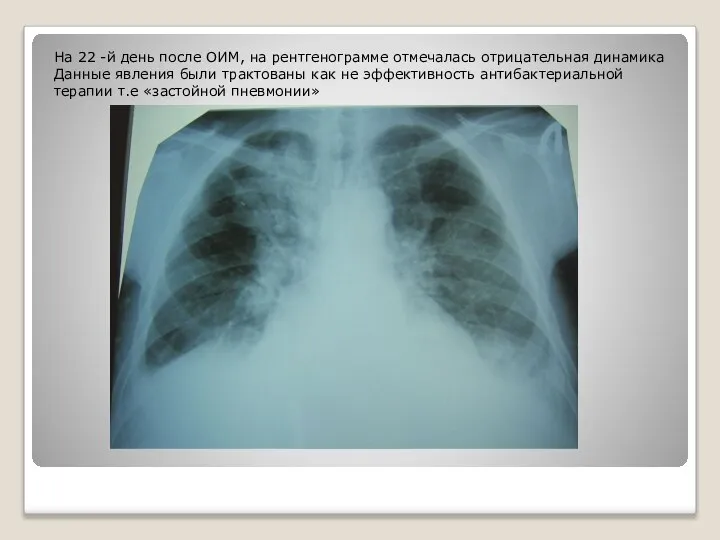На 22 -й день после ОИМ, на рентгенограмме отмечалась отрицательная динамика Данные