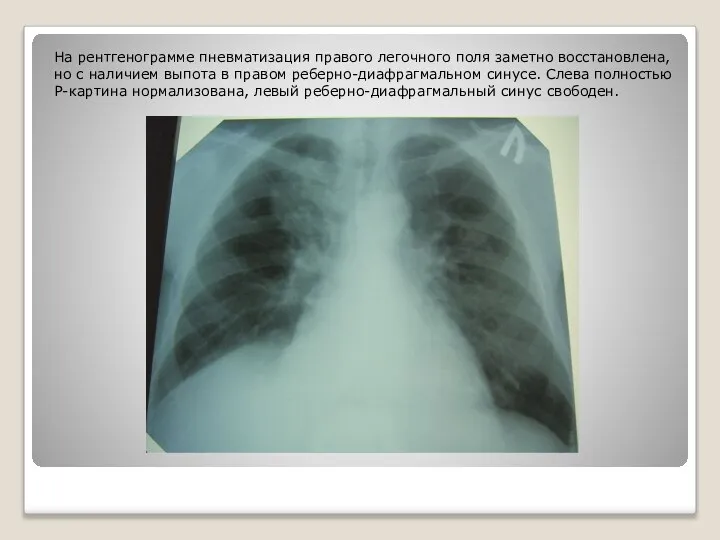 На рентгенограмме пневматизация правого легочного поля заметно восстановлена, но с наличием выпота