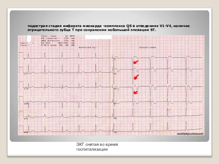 подострая стадия инфаркта миокарда -комплекса QS в отведениях V1-V4, наличие отрицательного зубца