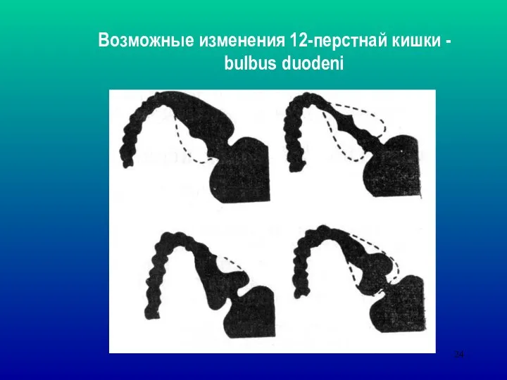 Возможные изменения 12-перстнай кишки - bulbus duodeni